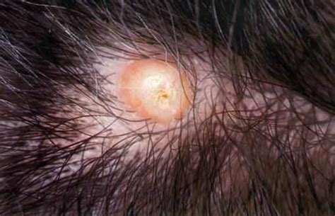 Ingrown hair in scalp pictures. Sep 13, 2017 · Ingrown Hair on Scalp Pictures. How does ingrown hair on the scalp look like? To assist you understand how shaving bumps on your scalp look like; below are some picture of infected ingrown hair on your head. There are also more images and photos in the article to help you identify with your symptoms. 