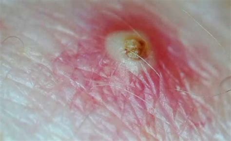 Ingrown hair on breast pictures. Ingrown hair and pilonidal sinus are the common and medical names of ... What is hemorrhoid? Perianal fistula · Pilonidal sinus (Ingrown hair) · Breast Cancer ..... 