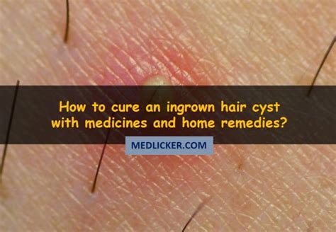 Ingrown hairs are caused by an inflammatory reaction, often after sha