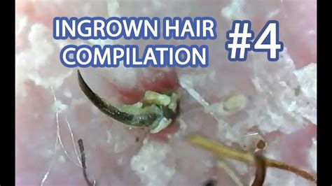 Ingrown hair popping. Things To Know About Ingrown hair popping. 