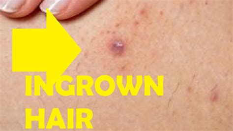If your ingrown hair is red and swollen, has turned into a hard lump under the skin, is tender to the touch or redness is spreading out from the area, see a doctor, as it may be infected, Dr. Greves says.. 