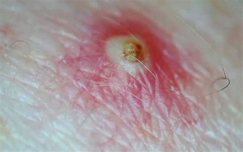 Ingrown pubic hair cyst photos. red, solid bumps (these may be round, or slightly cone shaped; the ingrown hair may be visible as a line or as a tiny dot, on or near the top of the bump) red bumps with pus-filled heads. itching ... 