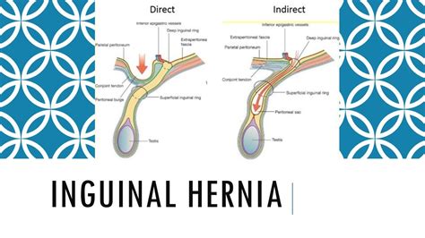 Inguinal Hernia vs. Umbilical Hernia: What