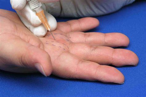 Injection for trigger finger cpt. Trigger finger. American Academy of Orthopaedic Surgeons. Trigger finger. Kaiser Permanente. Trigger finger (finger tenosynovitis). Dardas AZ, VandenBerg J, Shen T, Gelberman RH, Calfee RP. Long-term effectiveness of repeat corticosteroid injections for trigger finger. J Hand Surg Am. 2017;42(4):227-235. doi:10.1016%2Fj.jhsa.2017.02.001 