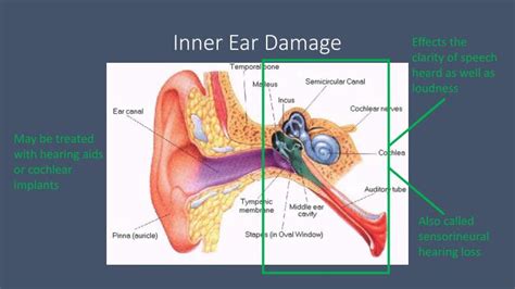 Inner Ear Damage and Its Impact on Hearing Audicus