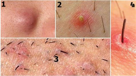A painful ingrown hair or cyst appearing on the thigh is a clear sign that the bump is infected. The infection could result in various reasons. This could include such things as touching the bump with dirty hands, picking or tweezing with dirty sharp object or failure to maintain good standards of body hygiene.. 