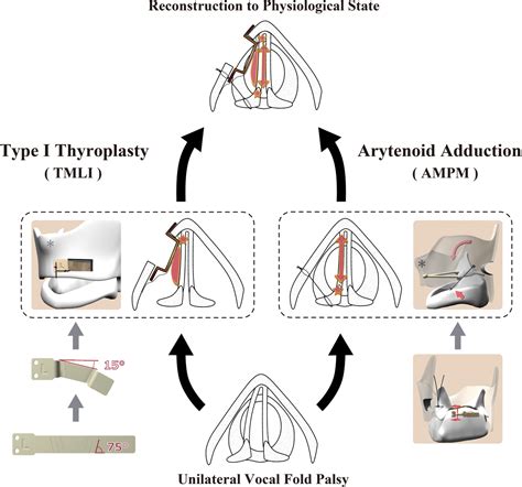 Inpatient Type 1 Thyroplasty Versus Injection Laryngoplasty