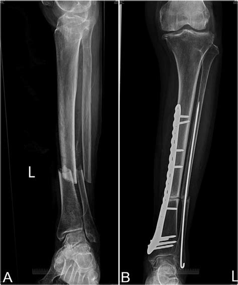 Insufficiency fractures of the tibia and fibula - ScienceDirect