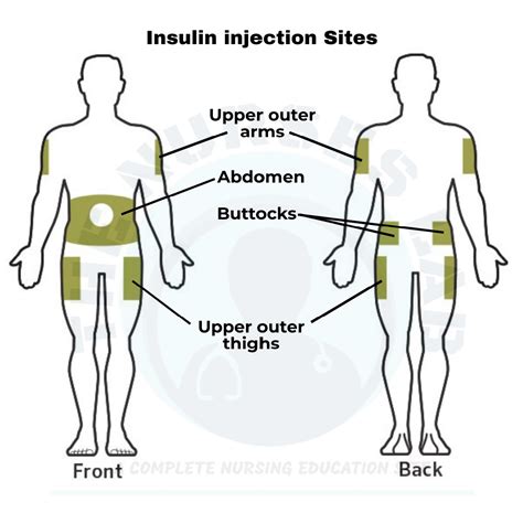 Insulin Injection Sites Diagram Printable