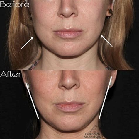 Insurance for masseter botox. Things To Know About Insurance for masseter botox. 