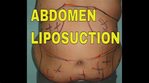 Insuring Safety in Large Volume Liposuction - Dr. Newall