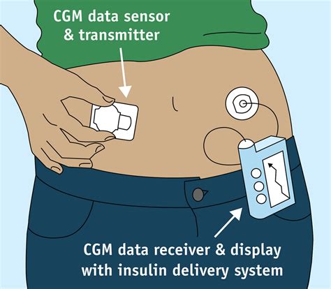 Integrated insulin pump therapy with continuous glucose …