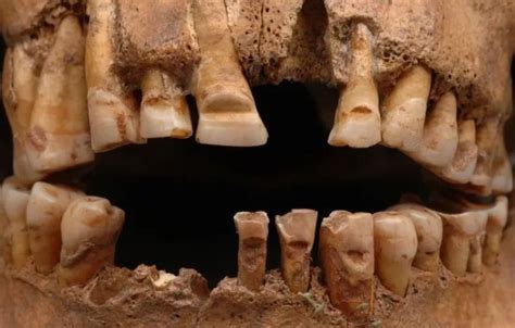 Intentionally Modified Teeth Among the Vikings: Was It …