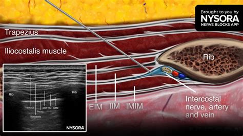 Intercostal Neuralgia - PubMed