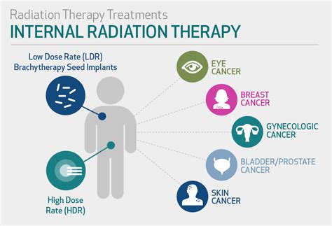 Internal Radiation Therapy (Brachytherapy)