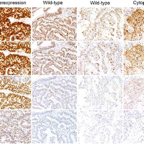 Interpretation of P53 Immunohistochemistry in Endometrial Ca ... - LWW