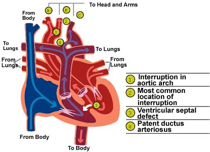 Interrupted Aortic Arch - CS Mott Children