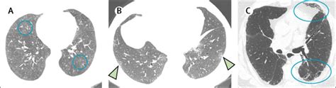 Interstitial Lung Abnormality Incidentally Detected on CT