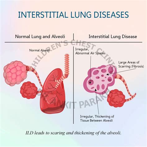 Interstitial lung abnormalities and interstitial lung diseases ...