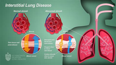 Interstitial lung disease.  Some types of autoimmune Learn about Interstitial Lun...