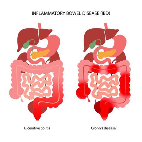 Intestine inflammation: Afrikaans translation, definition, meaning ...