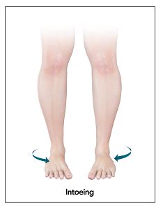 Genu valgum, commonly called "knock-knee", is a condition in which the knees angle in and touch each other when the legs are straightened. Individuals with severe valgus deformities are typically unable to touch their feet together while simultaneously straightening the legs. The term originates from the Latin genu, 'knee', and valgus which …. 
