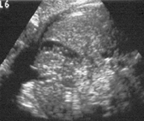 Intraabdominal fetal echogenic masses: a practical guide to