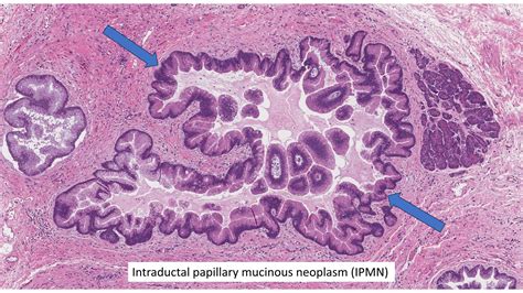 Intraductal Papillary Mucinous Cancer Of The …