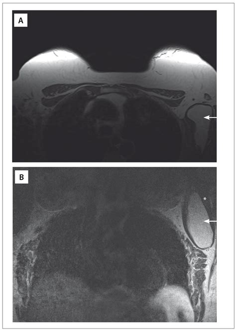 Intramuscular lipoma of the subscapularis muscle - PubMed