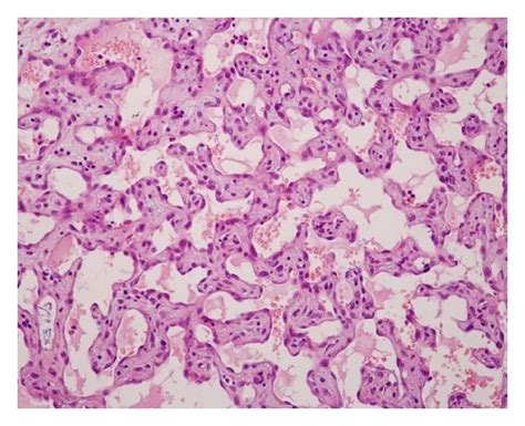 Intravascular papillary endothelial hyperplasia