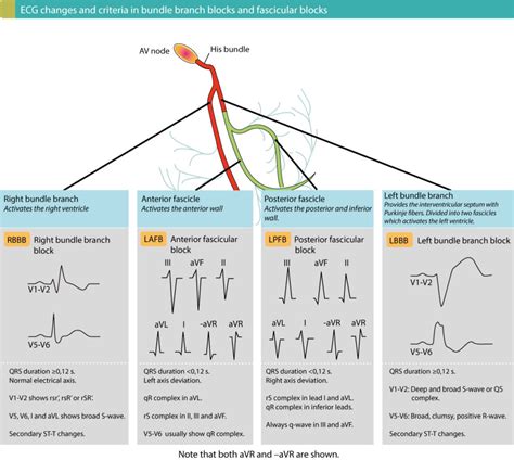 Intraventricular conduction delay: bundle branch …