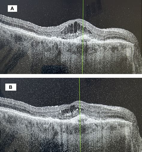 Intravitreal Faricimab for Age-related Macular Degeneration OPTH