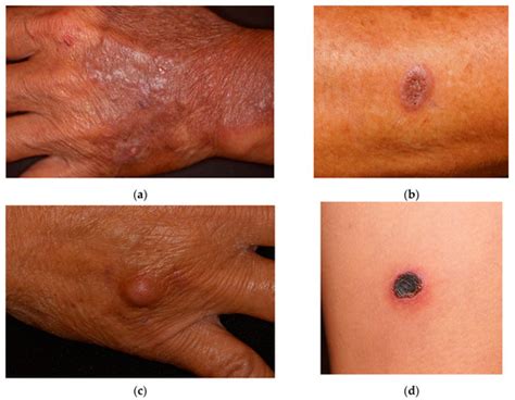 Invasive cutaneous infection with - Oxford Academic