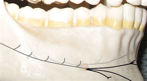 Investigating the incisive block: Procedure …