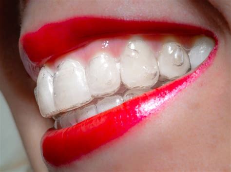 Invisalign SmartForce® Attachments Overbite and Underbite Correction