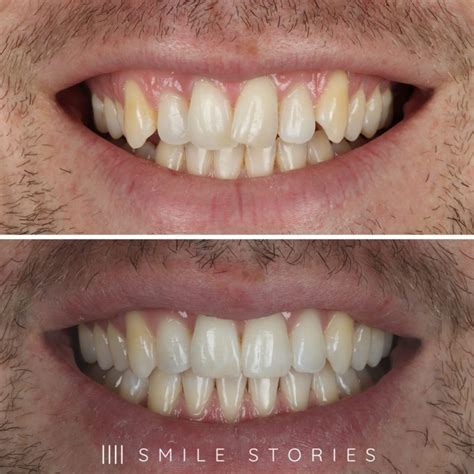 Invisalign Teeth Straightening Bournemouth Smile Stories