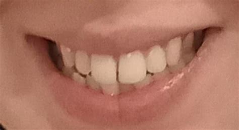 Invisalign ruined my face reddit.  That&rsquo;s why tooth loss can sometimes make the ...
