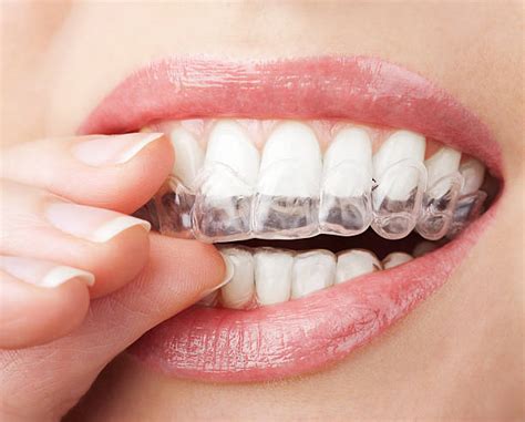 Invisalign stock. Things To Know About Invisalign stock. 