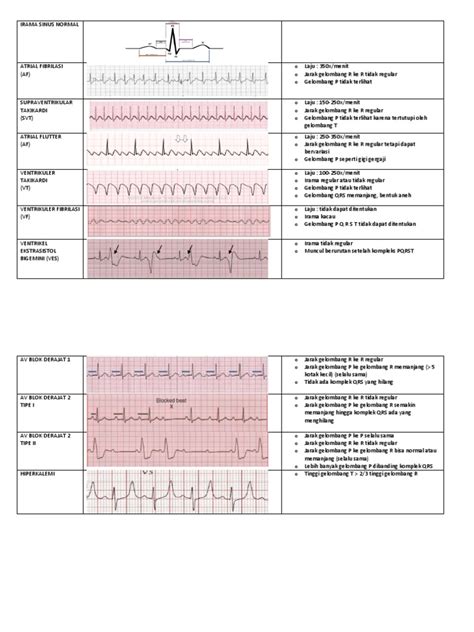 Irama jantung normal dan abnormal. .  <a href=https://bb-31.ru/vhdprv/how-do-hotel-mi...