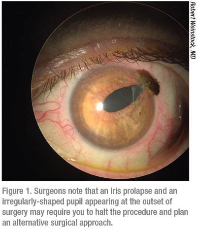 Iris Prolapse Treatment & Management: Medical Care, …