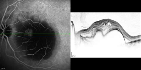 Irisangiographie mit Indocyaningrün SpringerLink