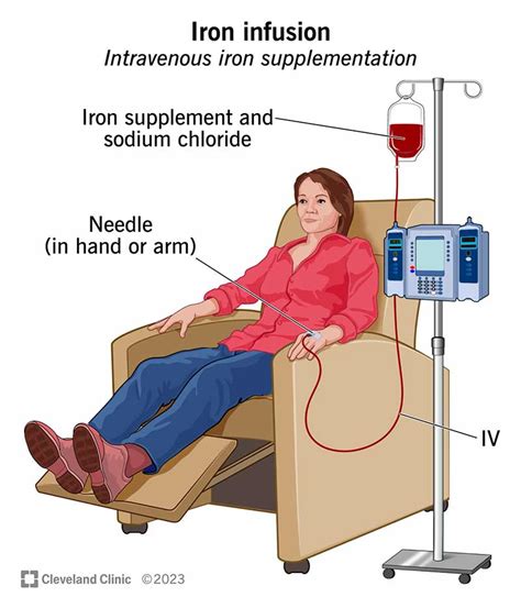 Iron iv infusion cost.  Often more than one infusion is needed.  The exa...