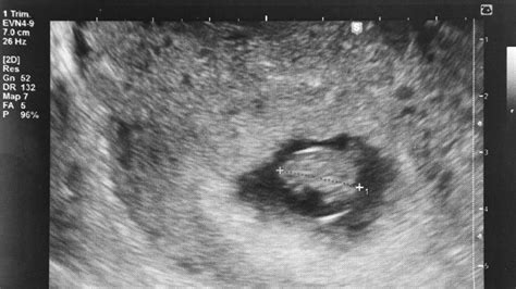 Irregular gestational sac at 7 weeks with heartbeat. A gestational sac without a yolk sac is observed but, seven to 13 days later, there is no embryo with a heartbeat; Absence of an embryo six or more weeks after the last menstrual period; Disproportionately small gestational sac in relation to the embryo (less than five millimeters difference between the mean sac diameter and the crown-to-rump ... 