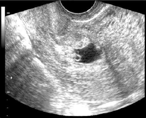 UrsaHoogle / Getty Images. The size of the gestational sac is measured in early pregnancy ultrasounds. With transvaginal ultrasound (an exam during which high-frequency sound waves produce an image), the gestational sac can be seen very early in pregnancy when its diameter is only about 2 to 3 millimeters. This usually occurs around five weeks .... 