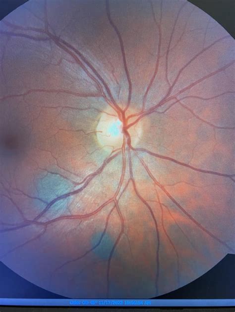 Is Fundus Photography useful? : r/optometry - Reddit