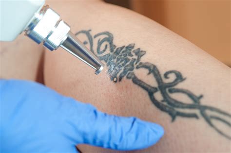 Is Laser Tattoo Removal Safe? - BetterTattooing.com