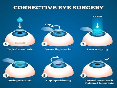 Is Lasik possible for both cylindrical and spherical powers?