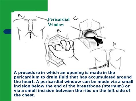 Is Pericardial Window Surgery Dangerous?