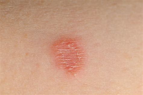 Is Ringworm Contagious? – American Kennel Club