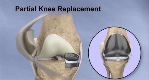 Is Second Knee Replacement Easier - HealthyKneesClub.com